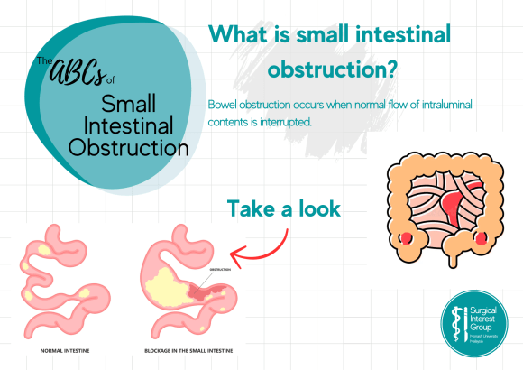ABCs of: Small Intestinal&nbsp;Obstruction